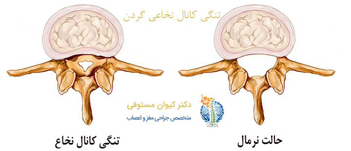 علت تنگی کانال نخاعی گردن