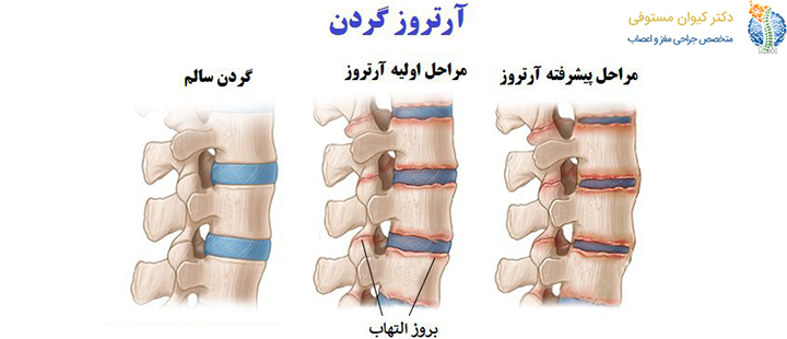 آرتروز گردن چیست؟