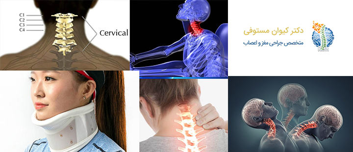 آشنایی با شکستگی مهره گردن
