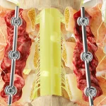 جراحی دیسک گردن چگونه است؟