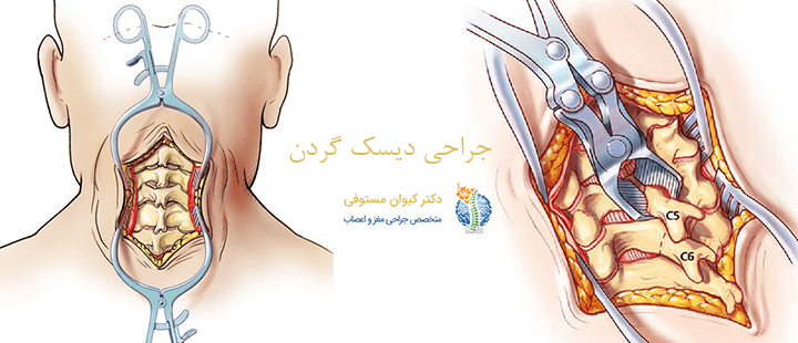جراحی دیسک گردن چیست؟