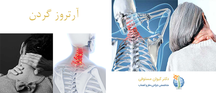 درباره آرتروز گردن 