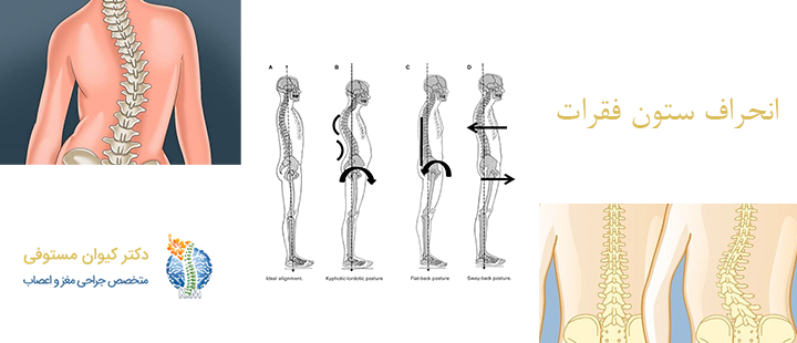 درباره انحراف ستون فقرات 