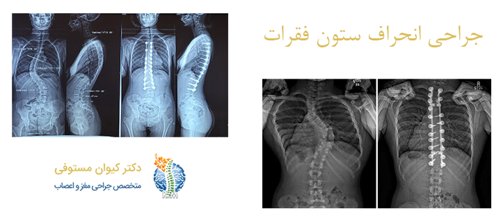 درباره جراحی انحراف ستون فقرات 