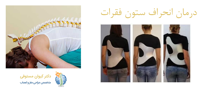 درباره درمان انحراف ستون فقرات 