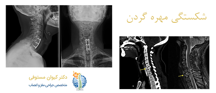 درباره شکستگی مهره گردن
