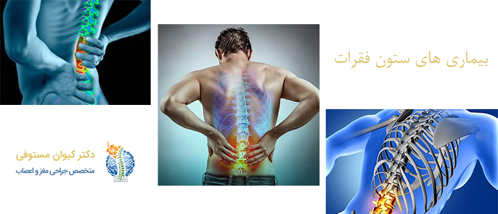 درباره بیماری های ستون فقرات 