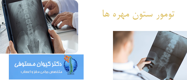 درباره تومور ستون مهره ها 