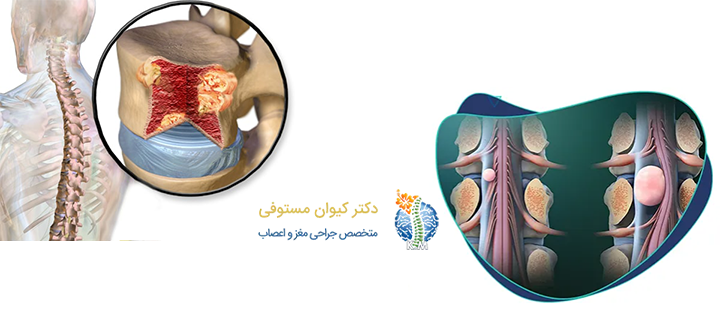درمان تومور ستون فقرات به چه صورت است؟
