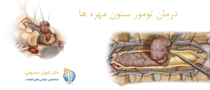 روش های درمان ستون مهره ها 