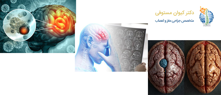 تومور مغزی بدخیم چیست؟
