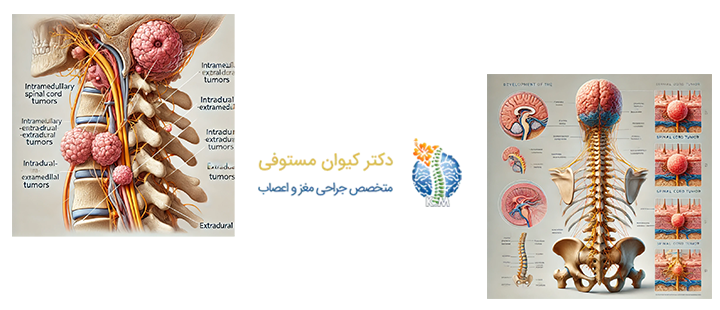 درباره تومور نخاعی 