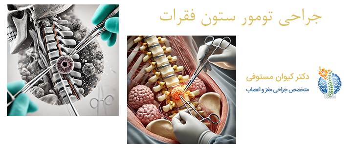 درباره جراحی تومور ستون فقرات 