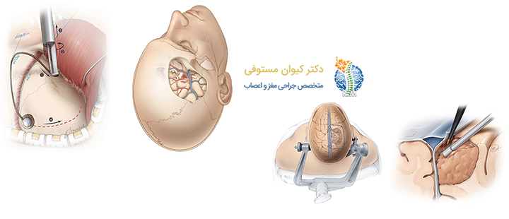 آشنایی با جراحی تومور مغزی 