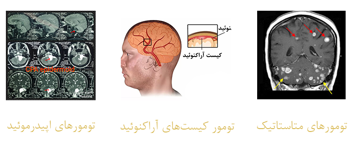 تومور سی پی انگل چه انواعی دارد؟