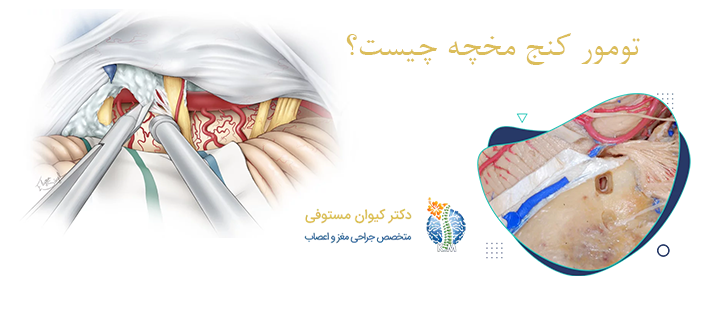 درباره تومور کنج مخچه 