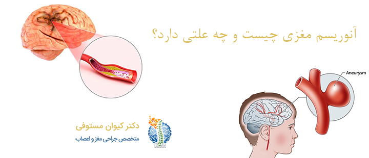 آنوریسم مغزی چیست و چه علتی دارد؟