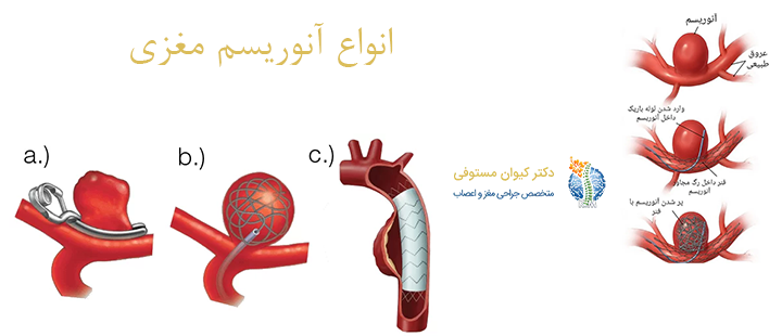 انواع آنوریسم مغزی