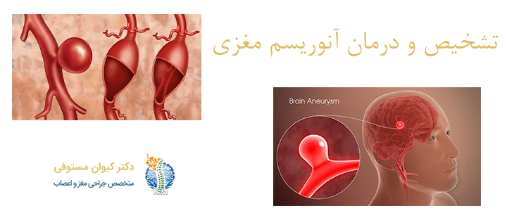 تشخیص و درمان آنوریسم مغزی 