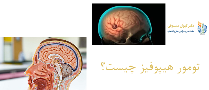 تومور هیپوفیز چه علائمی دارد؟