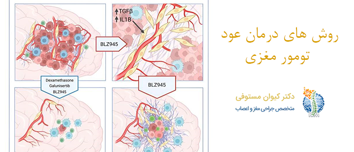 روش های درمان عود تومور مغزی