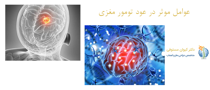 عوامل موثر در عود تومور مغزی