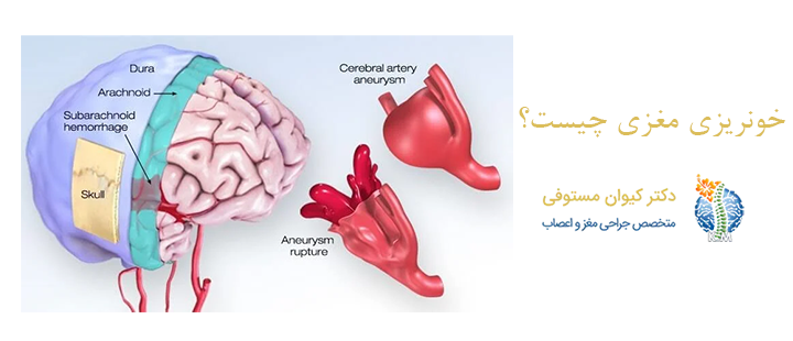 درباره خونریزی مغزی 