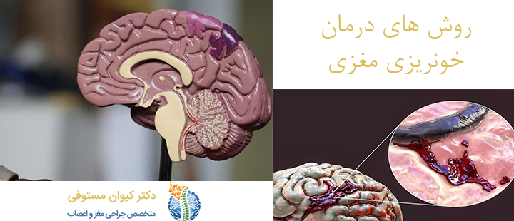 روش های درمان خونریزی مغزی 