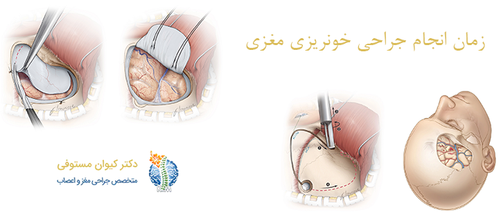 زمان انجام جراحی خونریزی مغزی 