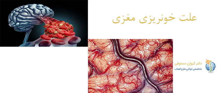 علت خونریزی مغزی 