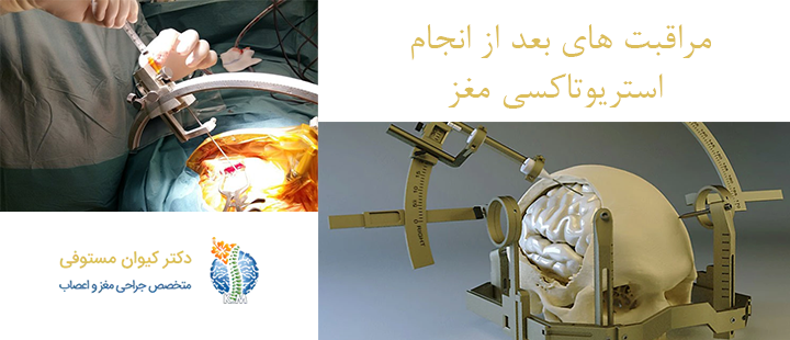 مراقبت های بعد از انجام استریوتاکسی مغز
