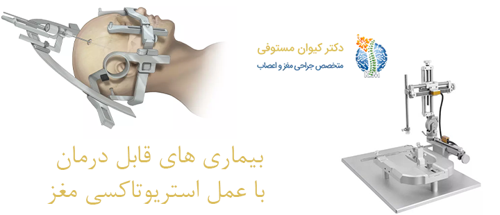 چه بیماری‌ هایی با استفاده از استریوتاکسی درمان می‌شوند؟