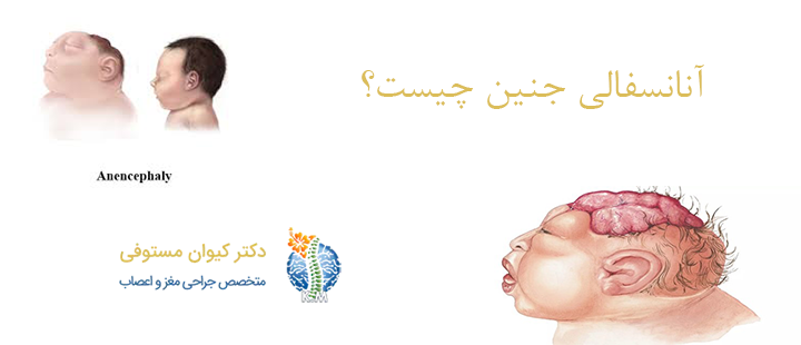 آنانسفالی جنین چیست؟
