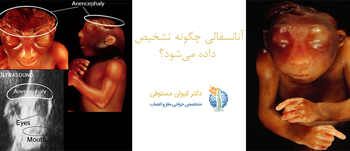 آنانسفالی چگونه تشخیص داده می‌شود؟