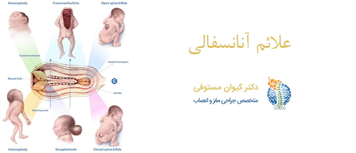 علائم آنانسفالی 
