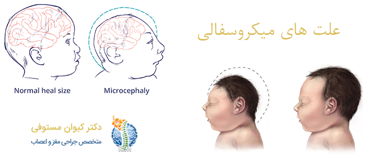 علت های میکروسفالی